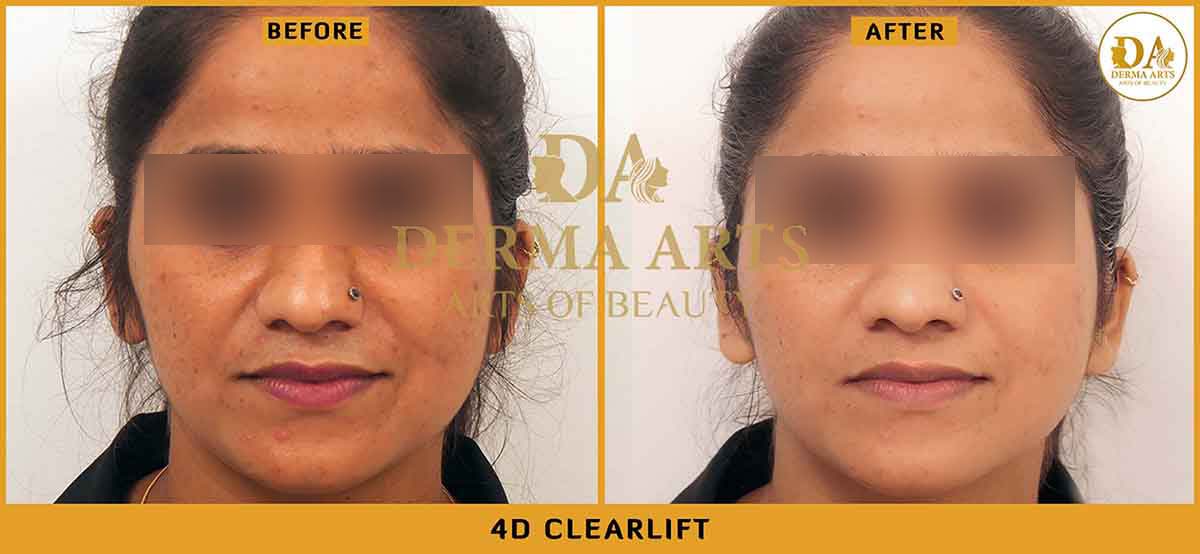 Delhi Clearlift before and after